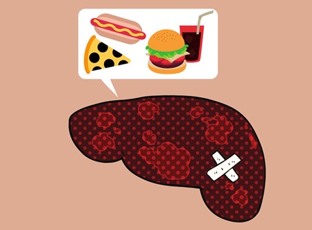 A poor diet can lead to fatty deposits and inflammation in the liver, which if not treated can result in cirrhosis.