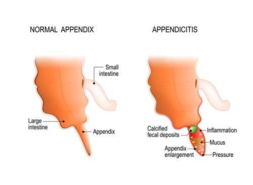 Appendicitis is the inflammation of the wall of the appendix caused by a blockage by a piece of stool, lymphatic tissue or even a tumor. However, sometimes a blockage and inflammation can occur for no reason at all.