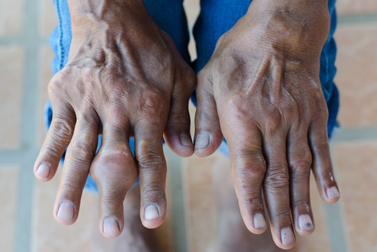 While gout most often appears in the joints of the big toe, the condition can affect other areas of the body, including the hands, knees, elbows and even ears.