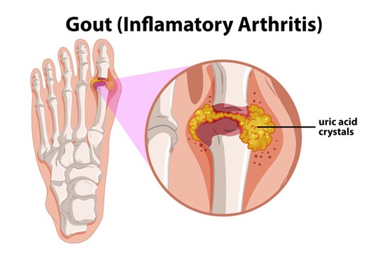 Gout is characterized by painful swelling in a single joint caused by excess levels of uric acid in the body and crystal deposits in the joints.