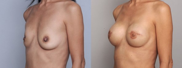 breast-before-after