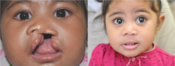 cleft-before-after-girl