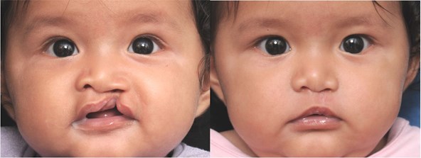 cleft-before-after-girl-2