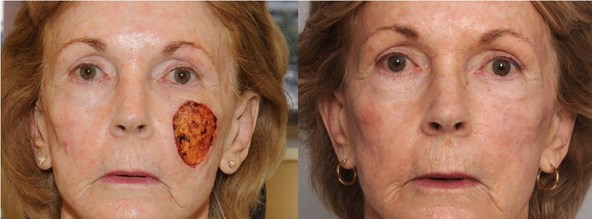 skin-cancer-before-after-cho