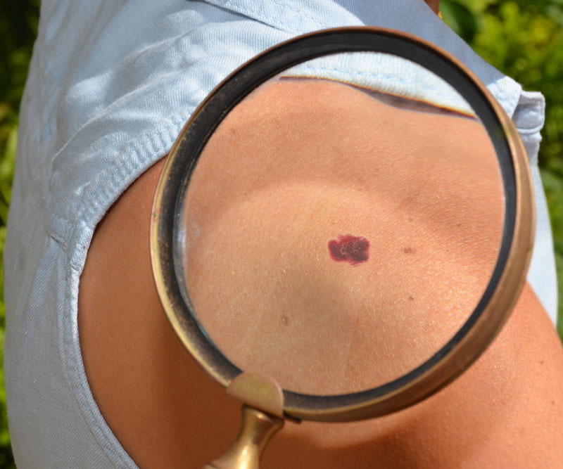 magnified spot of patient's skin cancer