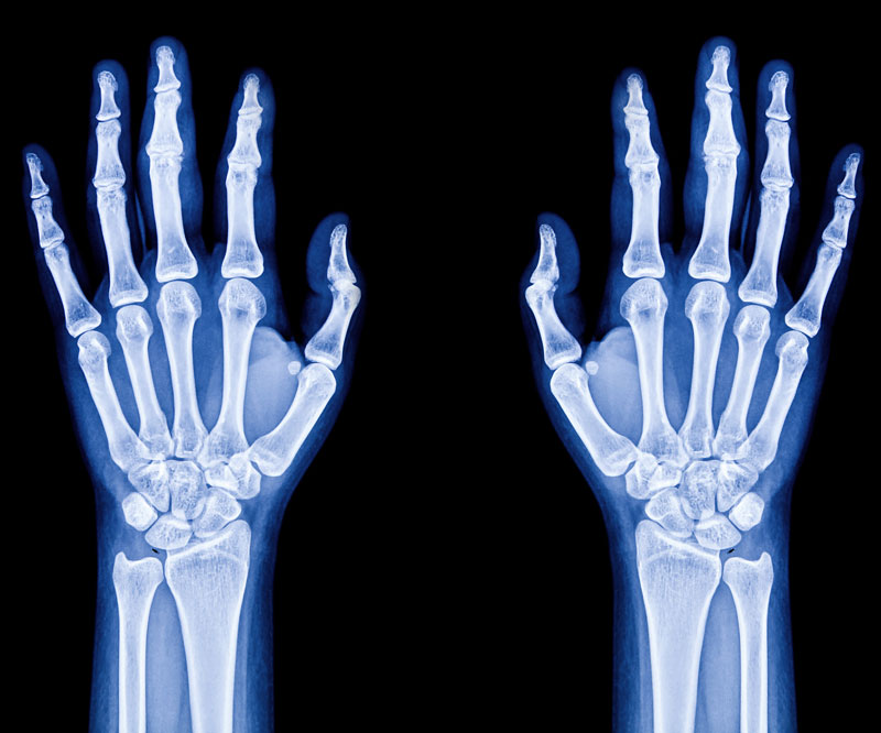 x-ray of two hands