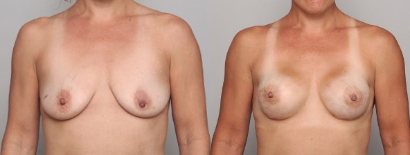 breast-recon-01112017