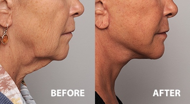 Lower face lift and neck lift patient before and after surgery
