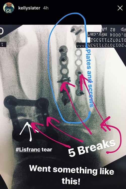 A screenshot from Kelly Slater's Instagram account in July 2017 shows the severity of his injury. It revealed five different breaks, a Lisfranc tear, and screws and plates that were inserted along two of his toes. Photo courtesy of @kellyslater/Instagram