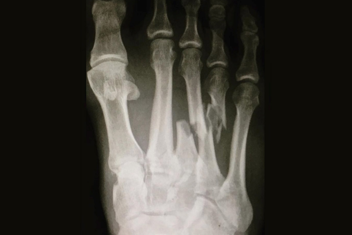 A radiographed photo of Kelly Slater's photo injury shows the broken metatarsal bones in the middle of the foot