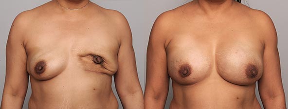 Revisionary-Breast-Reconstruction
