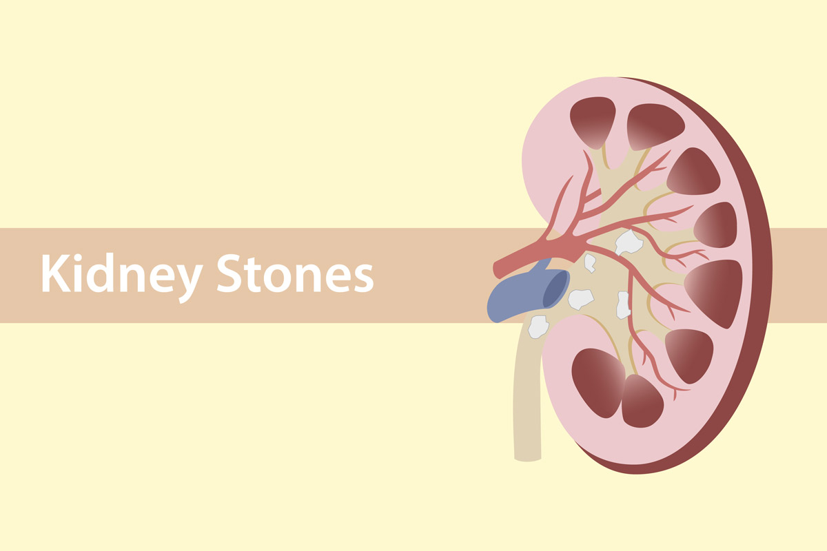 A cross-sectional diagram of a kidney with kidney stones