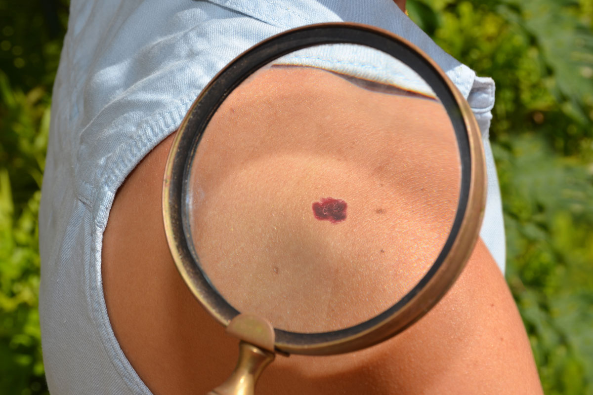 magnified spot of patient's skin cancer
