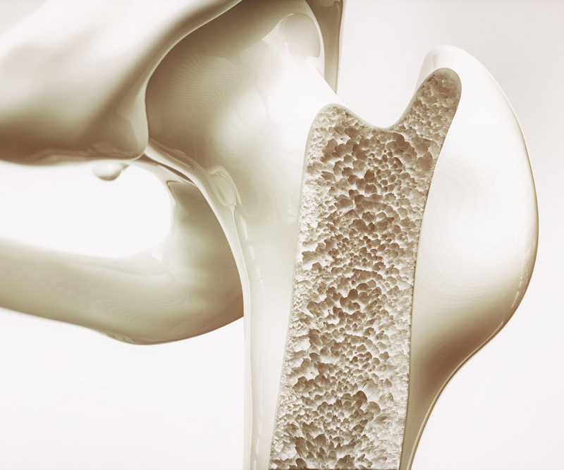 3-D image of bone with osteoporosis