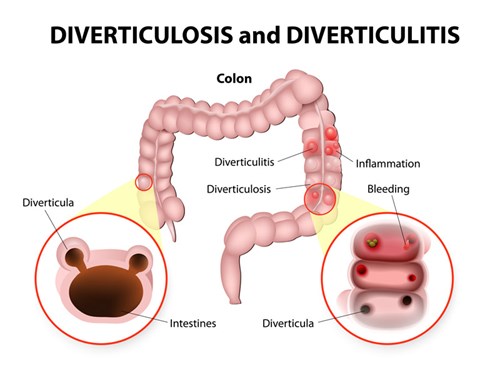 Diverticulitis is an acute infection and complication of diverticulosis. While diverticu<em>losis</em> is relatively benign and often asymptomatic – meaning it produces no symptoms – diverticu<em>litis</em> can lead to life-threatening complications.