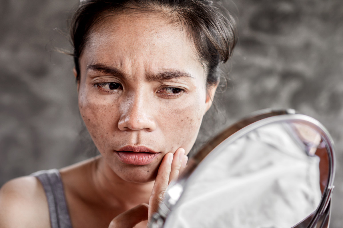 woman with melasma examining at skin in mirror