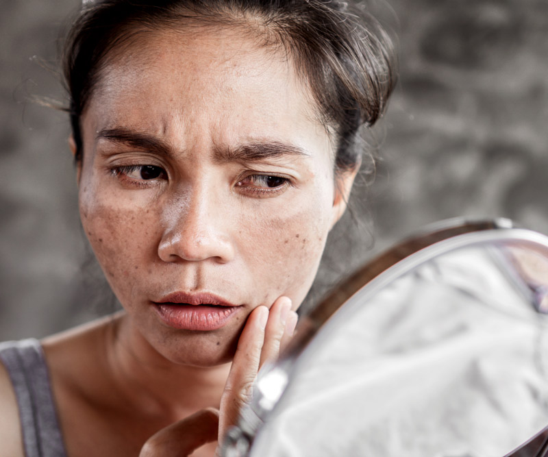 woman with melasma examining at skin in mirror