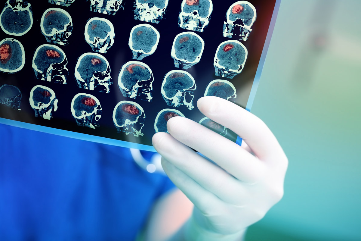 a physician wearing blue scrubs and a white glove holds up a scan of a brain that has red areas shaded to indicate a stroke