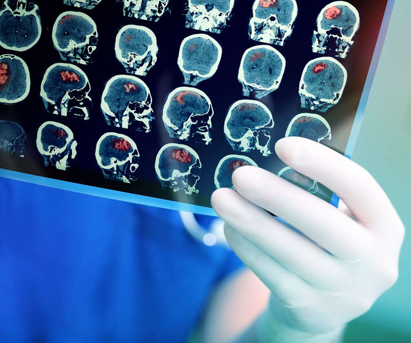 a physician wearing blue scrubs and a white glove holds up a scan of a brain that has red areas shaded to indicate a stroke