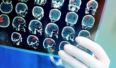 a physician wearing blue scrubs and a white glove holds up a scan of a brain that has red areas shaded to indicate a stroke