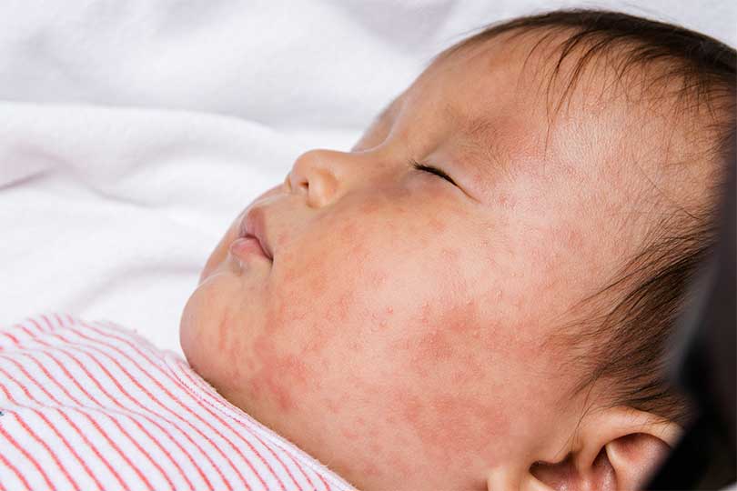 Child with measles rash on face.