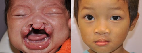 cleft-before-after