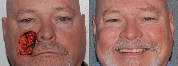 skin-cancer-before-after