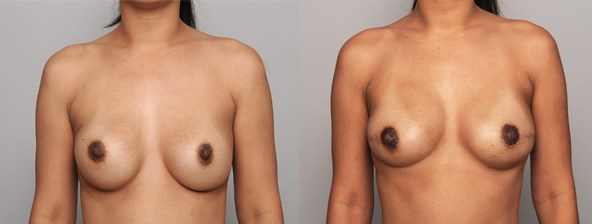 breast-cancer-recon