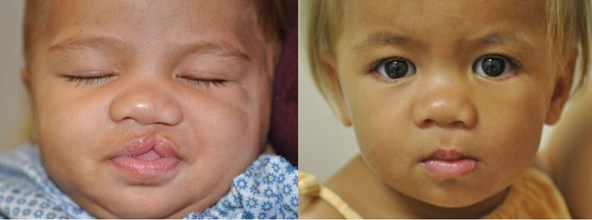cleft-surgery-before-after-cho