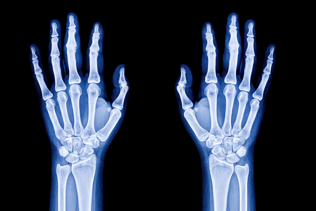 x-ray of two hands