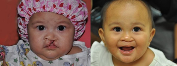 cleft-surgery-before-after-david-cho