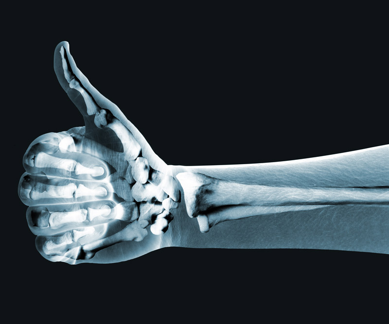 bone scan of an arm
