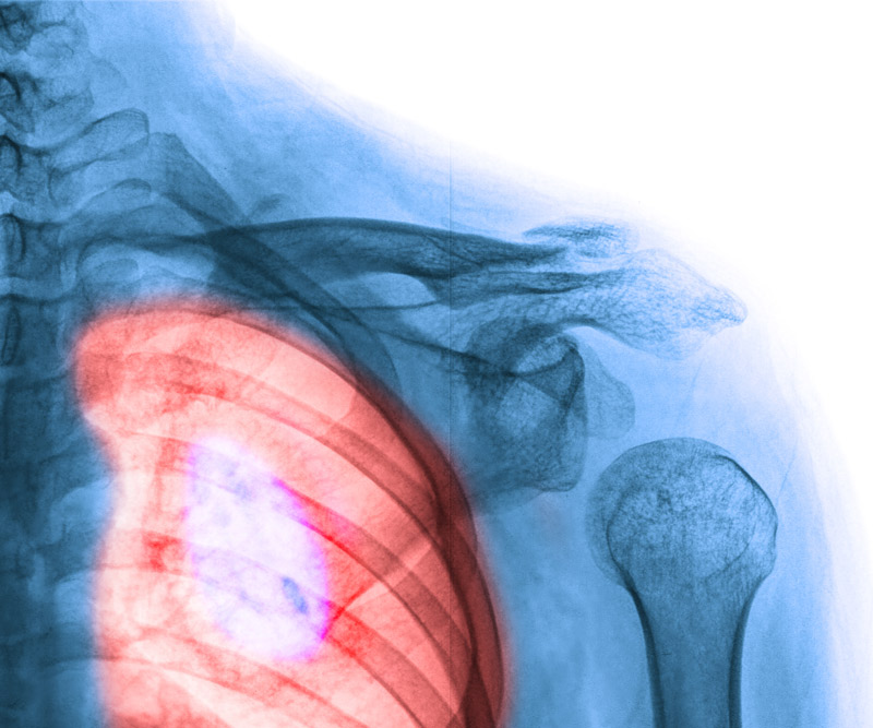 An X-ray image shows a human lung with an area highlighted in red to indicate lung cancer.