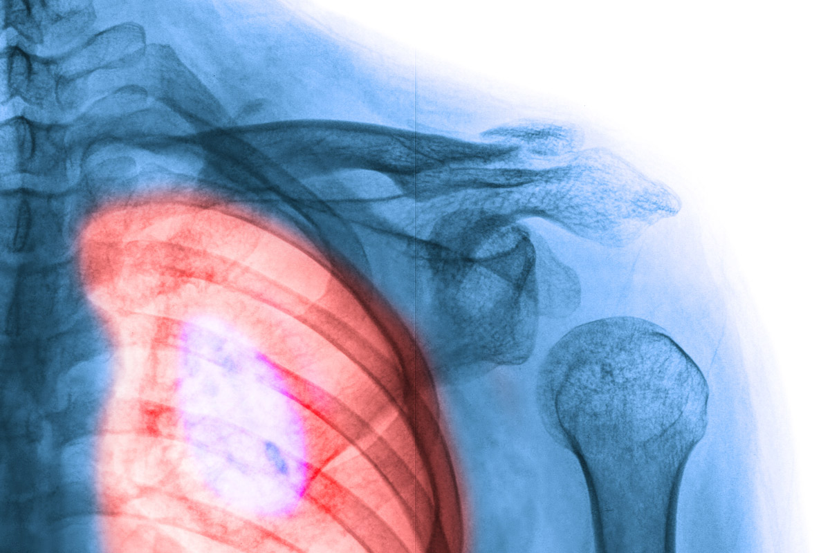 An X-ray image shows a human lung with an area highlighted in red to indicate lung cancer.