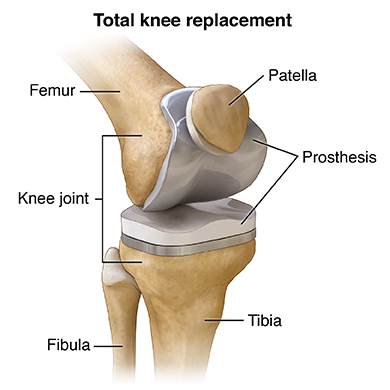 knee joint replacement devices