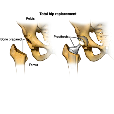 total-hip-replacement-image