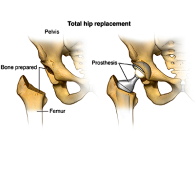 Total Hip Replacement