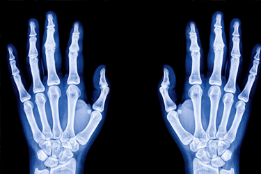 bone scan of man's hands