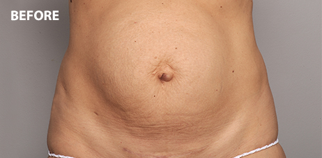 Tummy Tuck Surgery Honolulu Hawaii, Abdominoplasty