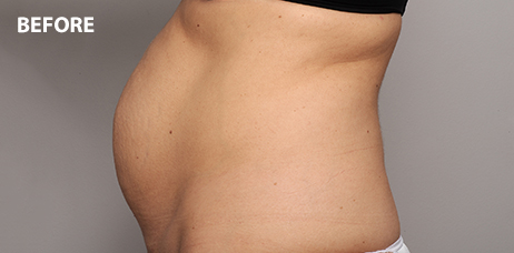 Tummy Tuck Surgery Honolulu Hawaii, Abdominoplasty