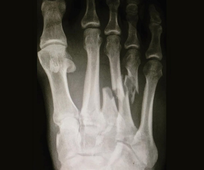 A radiographed photo of Kelly Slater's photo injury shows the broken metatarsal bones in the middle of the foot