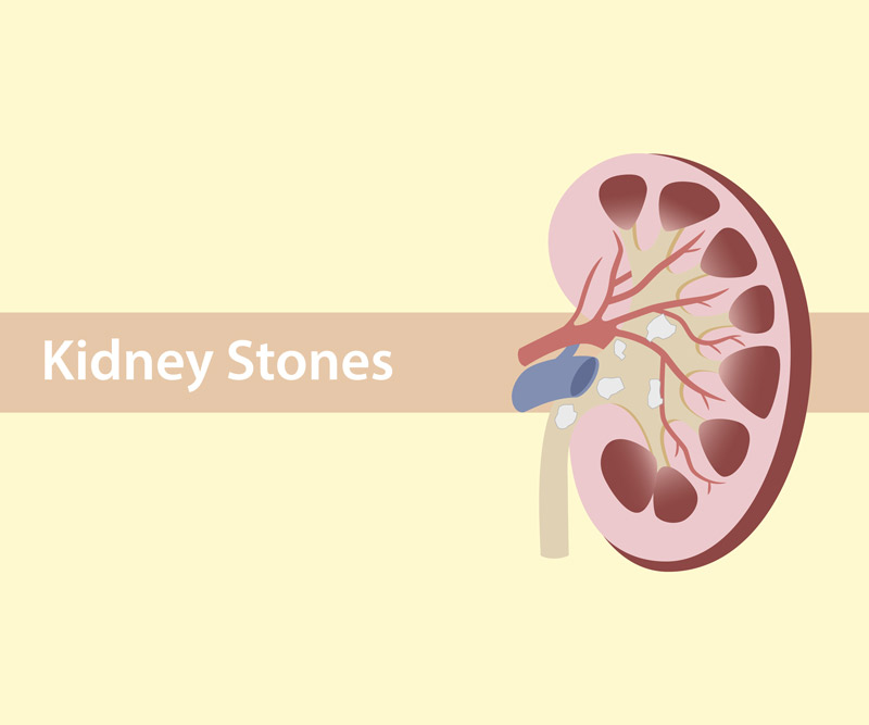 A cross-sectional diagram of a kidney with kidney stones