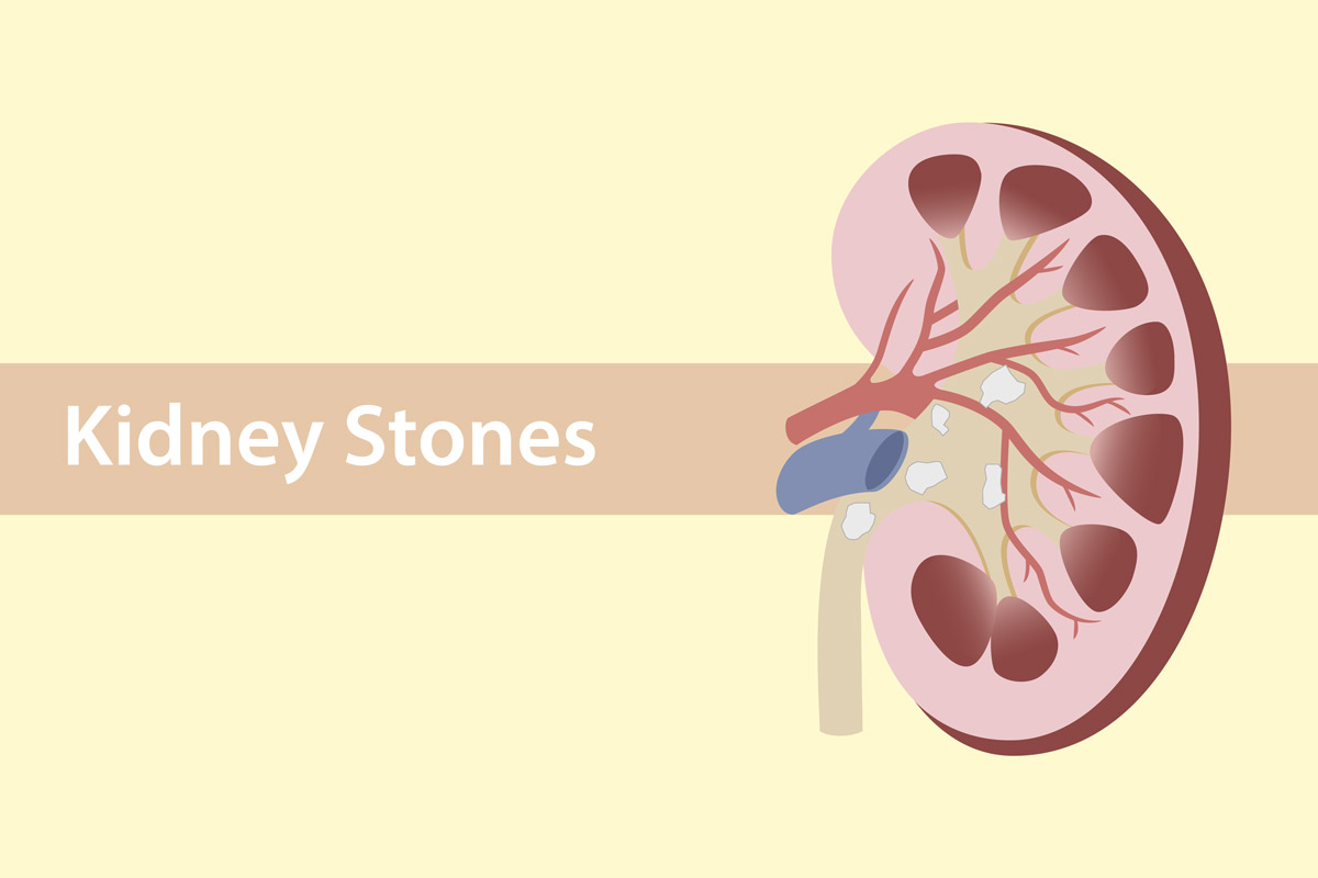 Kidney Stones: What’s Your Risk?