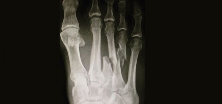 A radiographed photo of Kelly Slater's photo injury shows the broken metatarsal bones in the middle of the foot