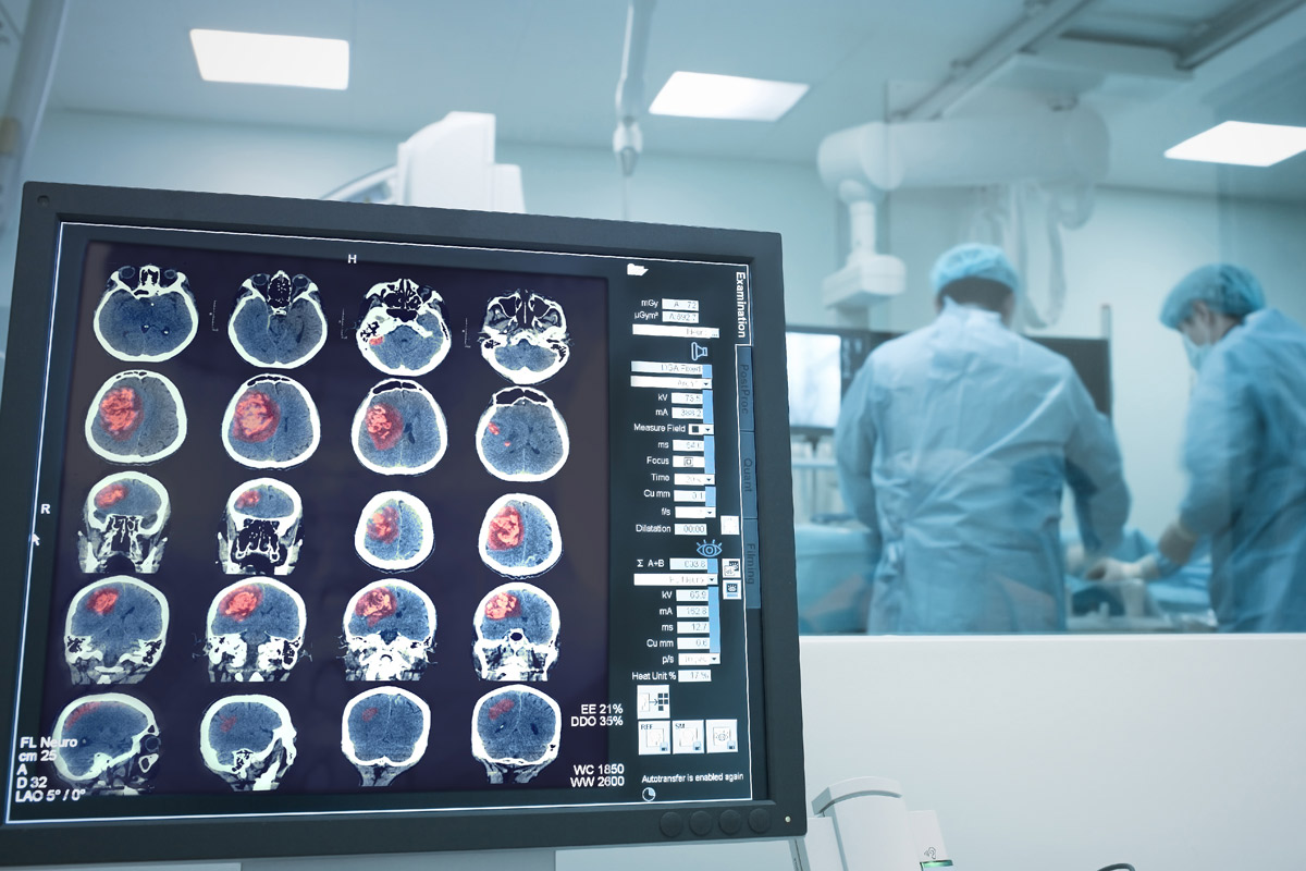 a computer monitor shows an xray of a stroke patient as surgeons perform emergency surgery in the background