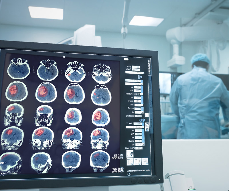 a computer monitor shows an xray of a stroke patient as surgeons perform emergency surgery in the background