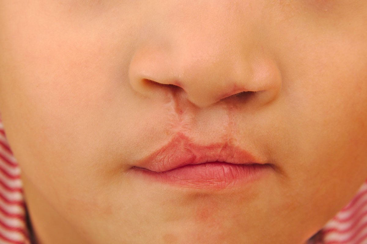 a close-up of a child with a repaired cleft lip