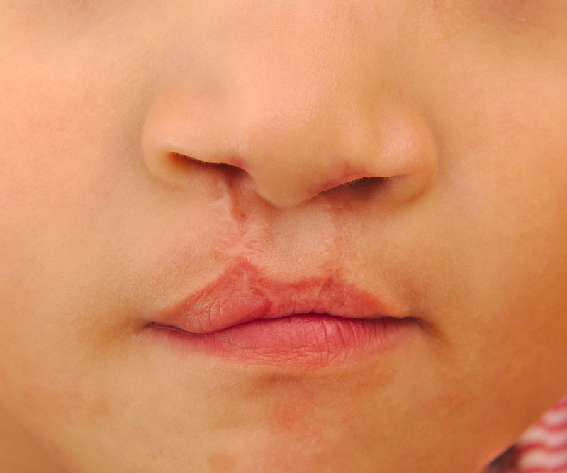 a close-up of a child with a repaired cleft lip