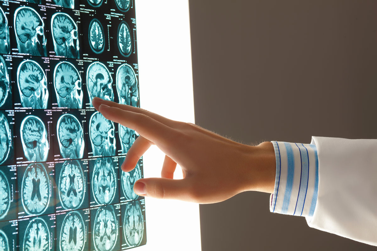 doctor pointing to brain scan X-ray