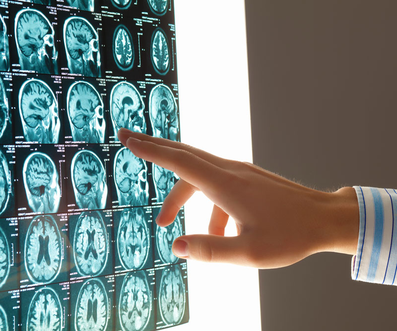 doctor pointing to brain scan X-ray